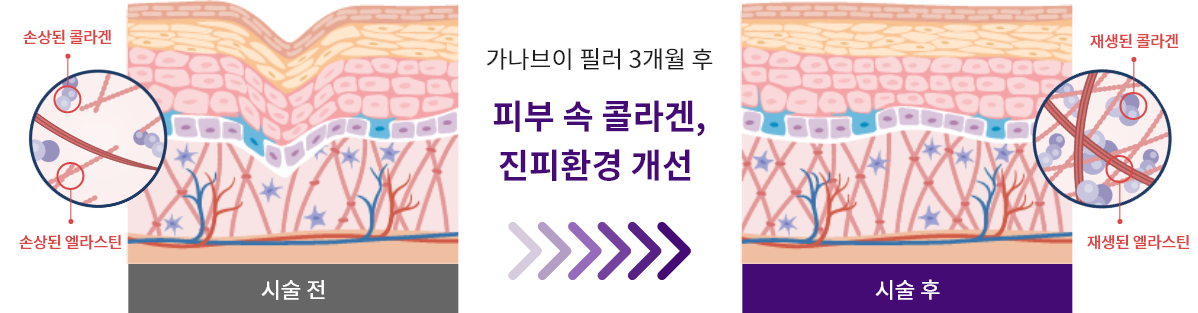 가나브이 필러