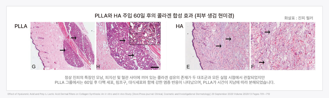 강력한 콜라겐 합성, 섬유아세포 증식