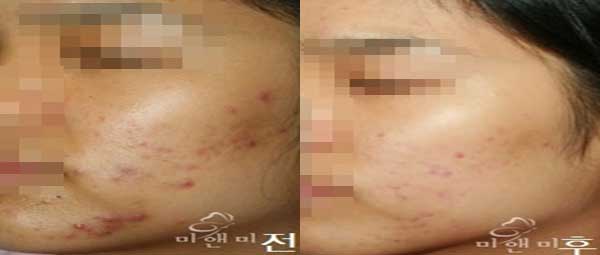 [시술전후사진]여드름치료-쿰스필시술전후