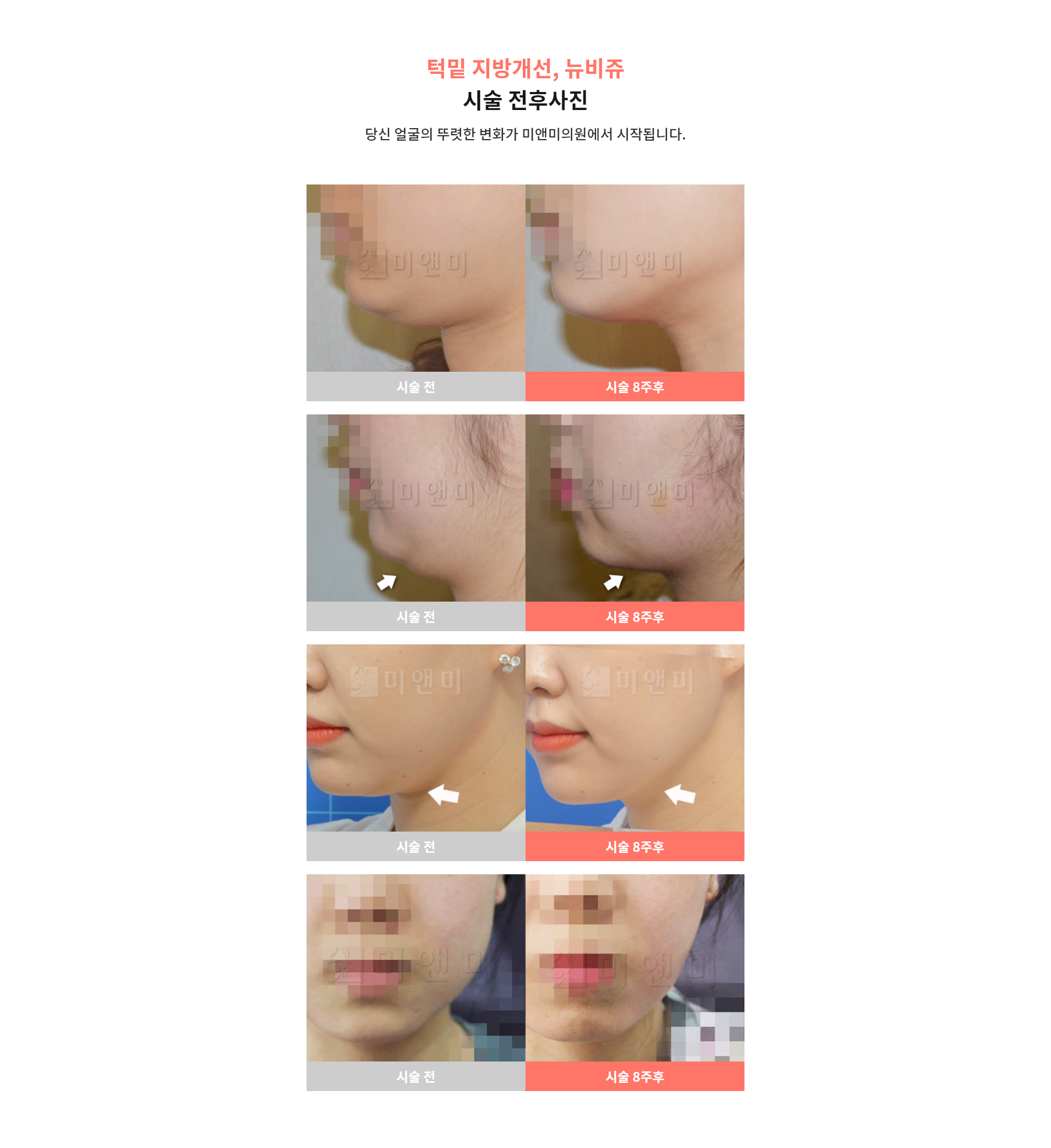 시술 전후사진, 뉴비쥬